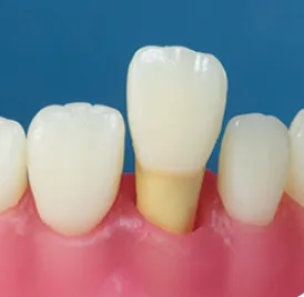 Radiopaque Endodontic Training Tooth, 11/UR1, Central Incisor