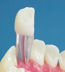 Transparent Endodontic Training Tooth, 11/UR1, Central Incisor