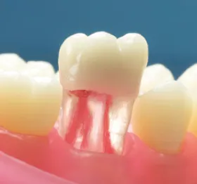 Transparent Endodontic Training Tooth, 46/LR6, First Molar