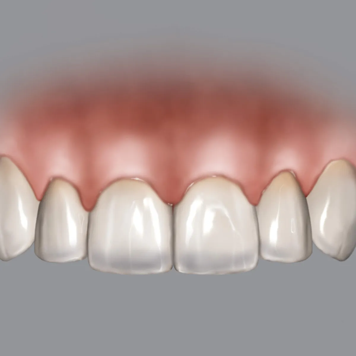 Chu Gauge BLPG Replacement Tips (3 Tips)